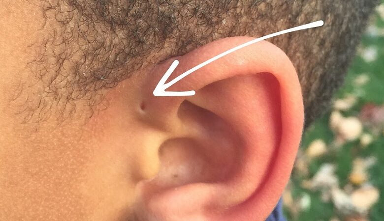 Rò luân nhĩ là gì, có phải là bệnh nguy hiểm không? | Medlatec