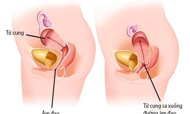Sa tử cung là gì và một số lưu ý chị em không thể bỏ qua | Medlatec