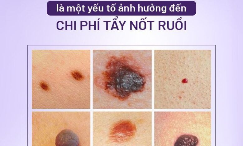 Tẩy nốt ruồi bao nhiêu tiền? Bảng giá tẩy nốt ruồi 2023
