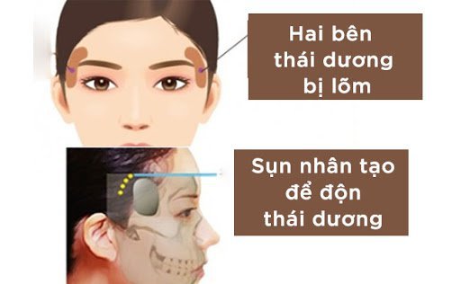 Thái dương lõm gây nên những ảnh hưởng gì?