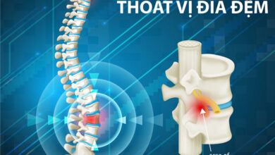 15 phương pháp điều trị thoát vị đĩa đệm hiệu quả nhất hiện nay