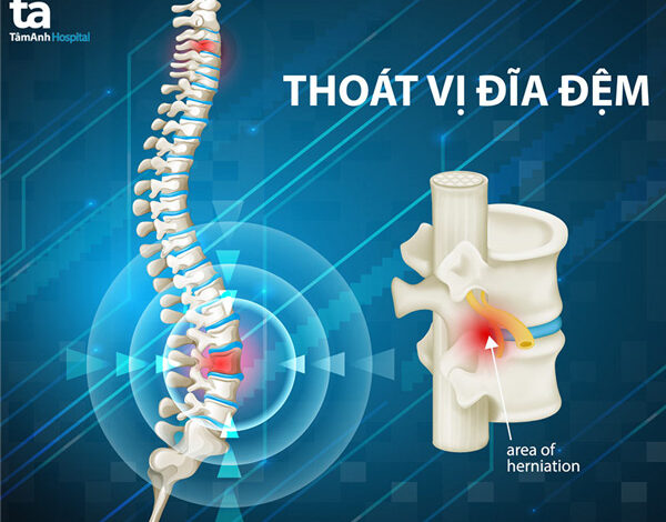 15 phương pháp điều trị thoát vị đĩa đệm hiệu quả nhất hiện nay