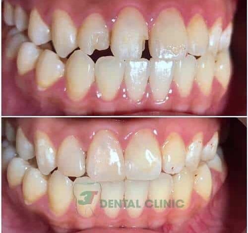 Trám Răng Cửa Thẩm Mỹ Có Bền Không & Trám ... - Nha Khoa 3T