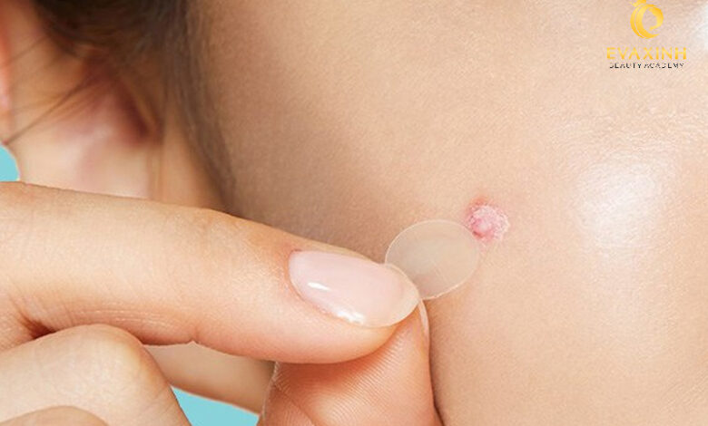 6 Bước Trang Điểm Che Mụn và Vết Thâm Đỉnh Cao Cho Chị Em