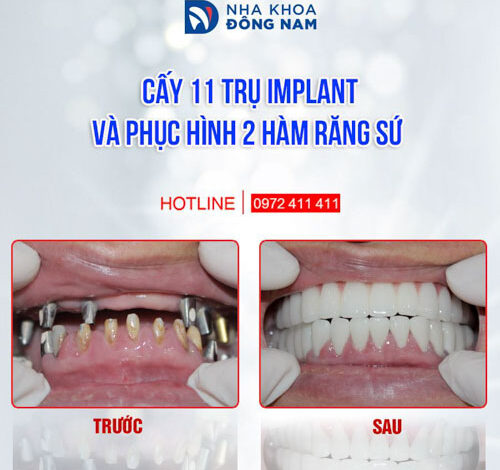 Bảng Giá Trồng Răng Giả 2023 (cập nhật mới nhất)