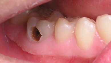 Trồng răng hàm bị sâu giá bao nhiêu và nên trồng loại răng nào?
