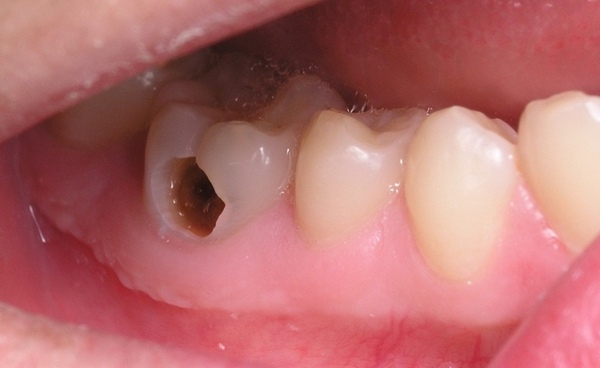 Trồng răng hàm bị sâu giá bao nhiêu và nên trồng loại răng nào?