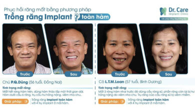 Bảng giá trồng răng Implant chuẩn y khoa tại Dr. Care [2023]