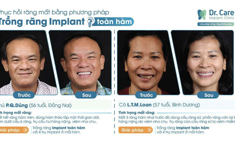 Bảng giá trồng răng Implant chuẩn y khoa tại Dr. Care [2023]