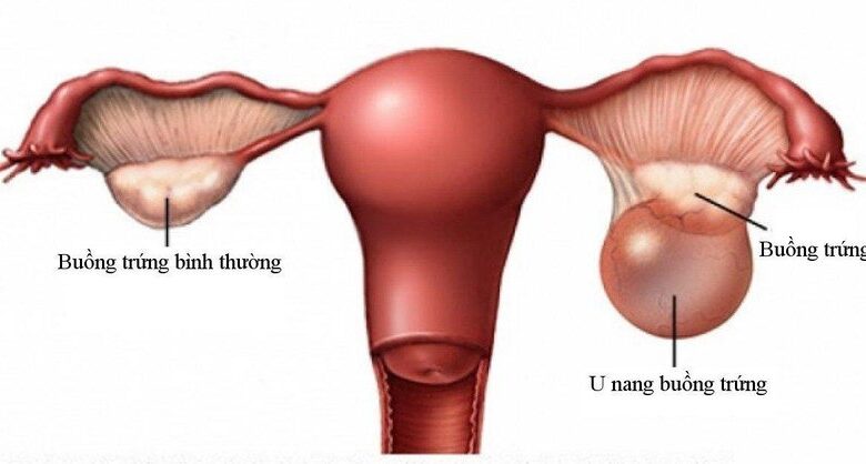 U nang buồng chứng có nguy hiểm không?
