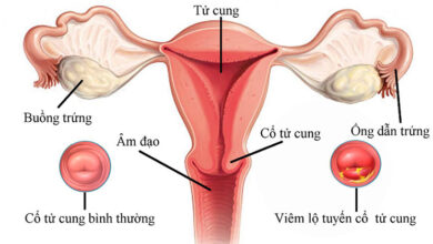 Nguyên nhân, triệu chứng và cách chữa viêm lộ tuyến cổ tử cung