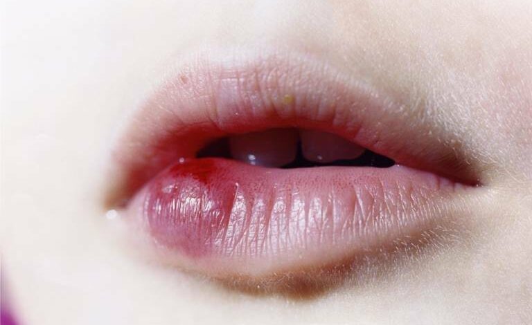 Phun Môi Bị Sưng Đỏ Bao Lâu Thì Hết? Uống Thuốc Gì Để Hết Sưng?